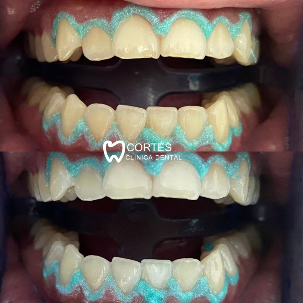 Blanqueamiento Dental